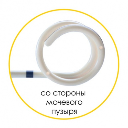 Мочеточниковый стент Urotech White Star